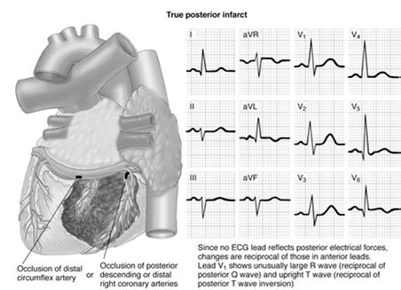 Right Ventricular Infarct Looks just like an inferior infarct Take lead V4 and place it 5th ICS MCL on the right side of the chest RVI suspected if ST elevation is present in that lead Usually this
