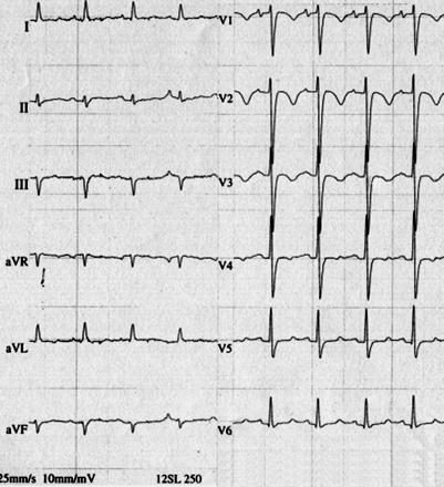 Pulmonary Embolism 12-lead ECG from a patient with a massive PE.