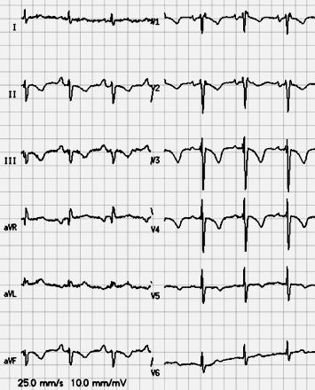 Carbon Monoxide Poisoning 12-lead ECG from a patient with severe CO poisoning (CO hemoglobin of 39.