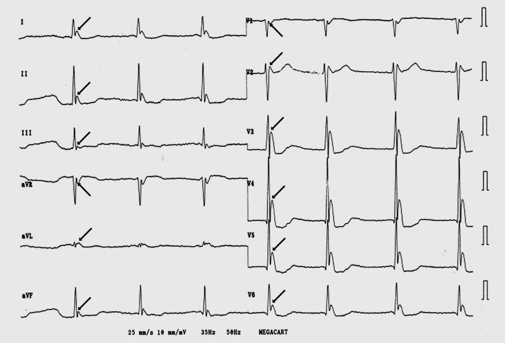 Hypothermia ECG from a patient with severe hypothermia (23.