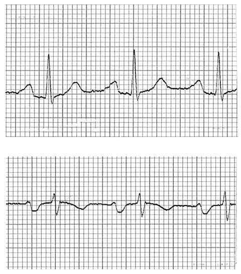 Left Atrial Enlargement Left atrial enlargement is illustrated by increased P wave duration