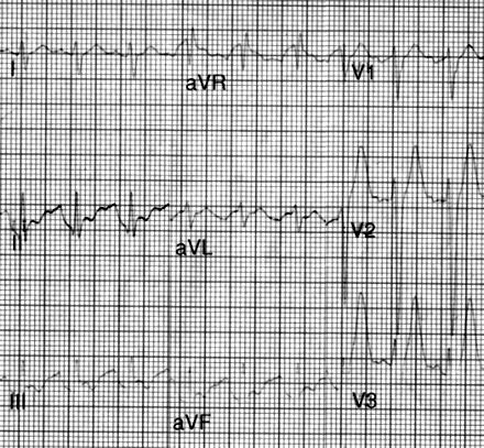 TCA Overdose ECG showing sinus tachycardia with widened QRS complex (110 ms) and marked deviation of the terminal portion of the QRS