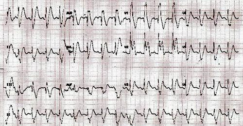 Myocardial Contusion ECG changes associated with myocardial contusion after blunt chest trauma