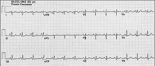 Right Atrial Enlargement RAE is recognized by the tall (>2.5mm) P waves in leads II, III, avf.