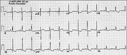 RAE/RVH In this case of severe pulmonary hypertension, RVH is recognized by the prominent anterior forces (tall R waves in V1-2), right axis deviation (+110