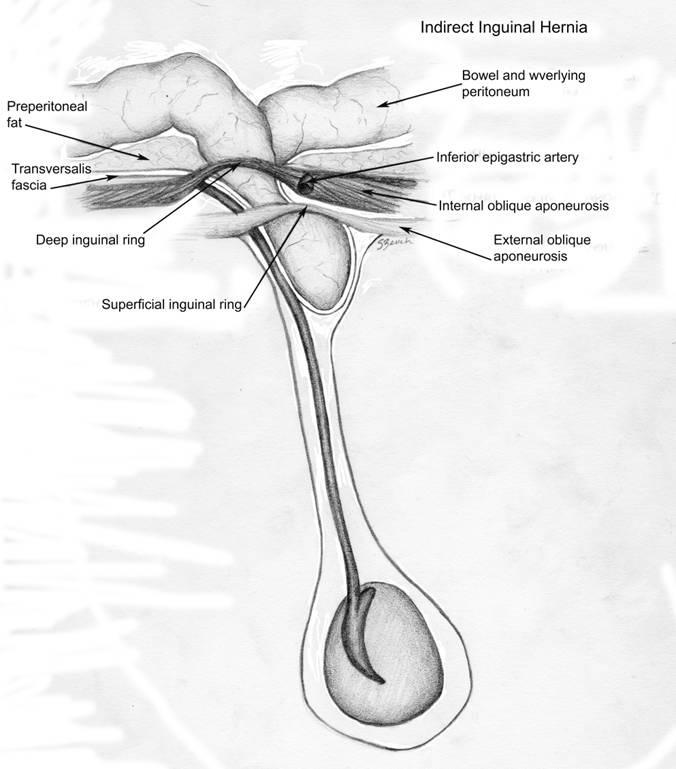 )277( Figure 3. Indirect Inguinal Hernia. By definition, the hernia enters the inguinal canal through the internal (deep) inguinal ring, lateral to the epigastric vessels.