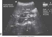 Junction seen to the left of the midline as a bull s-eye or target structure gastric antrum can be seen as