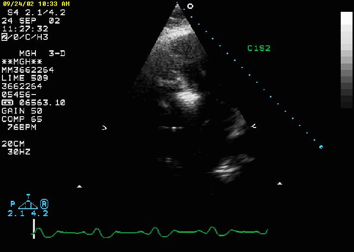 Contrast echo guidance S1 does not perfuse LV