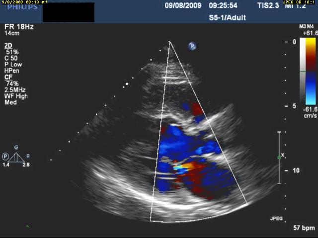 Reduction in MR post-ablation