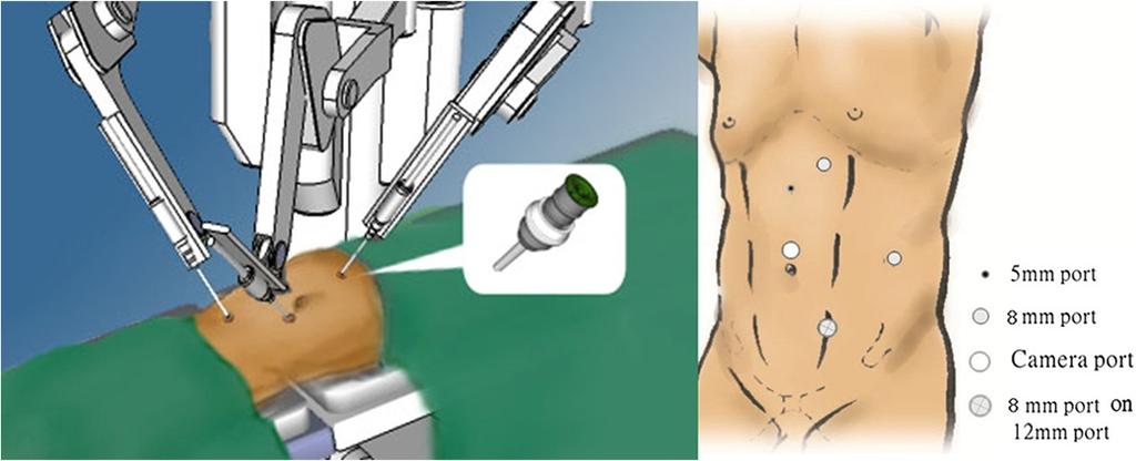Yang et al. World Journal of Surgical Oncology 2014, 12:219 Page 3 of 5 Figure 2 Port design for bladder cuff excision. chemotherapy.