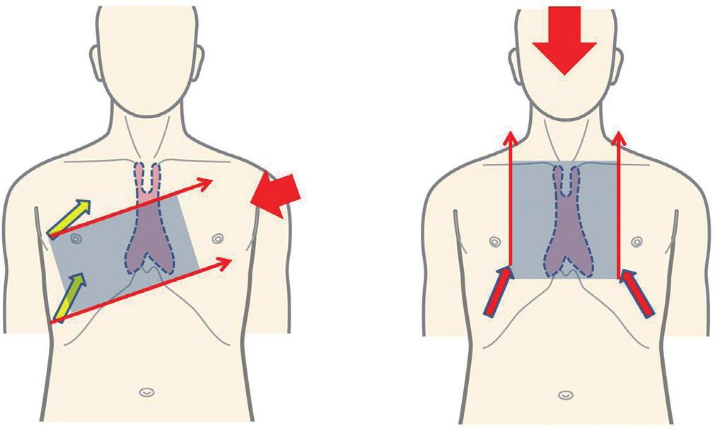 Figure 3 When the tumor is close to the brachiocephalic vein, the approach from the lateral chest cannot identify the contralateral brachiocephalic vein beyond the tumor (Lateral approach).