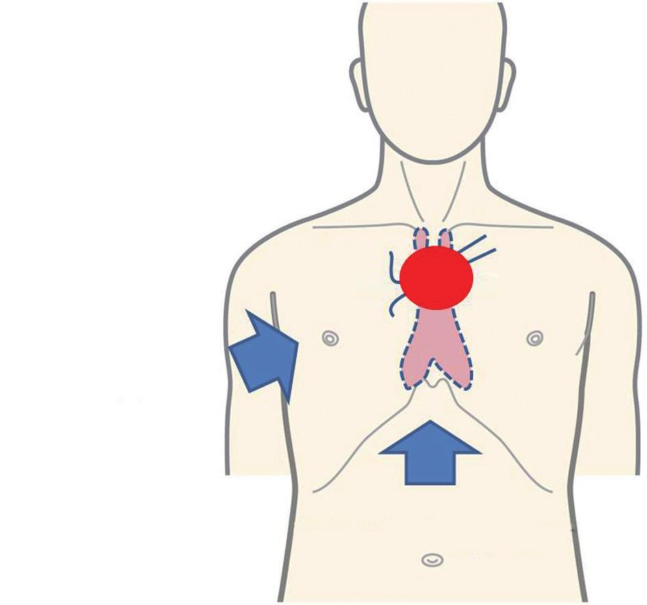 A Lateral approach Figure 2 With the approach from the lateral thoracic side, the neck portion of the thymus is not between the left and right arms (A).