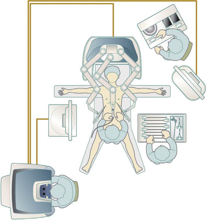 Journal of Visualized Surgery, 2016 Page 3 of 5 Figure 4 Equipment configuration with the da Vinci SI surgical system. method. Here we report on our RST technique.