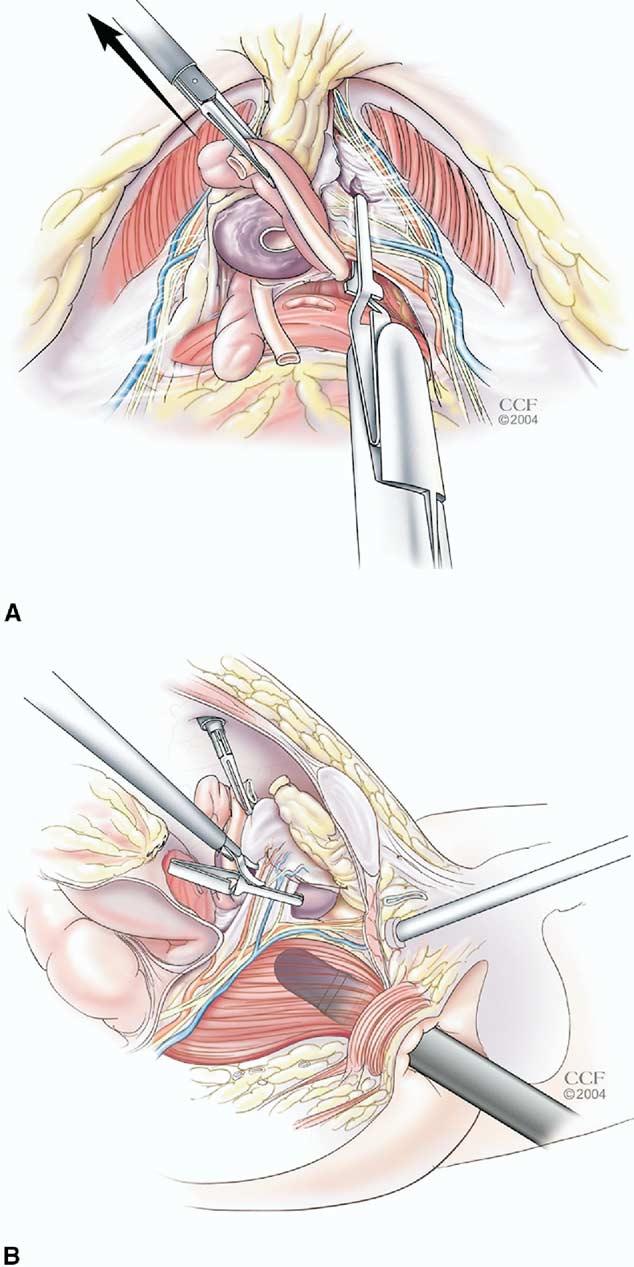 FIGURE 2. (A) Meticulous, superficial suturing (4-0 Vicryl) of transected lateral pedicle. (B) Intraoperative laparoscopic view of bilateral preserved NVBs (N) after laparoscopic prostatectomy.