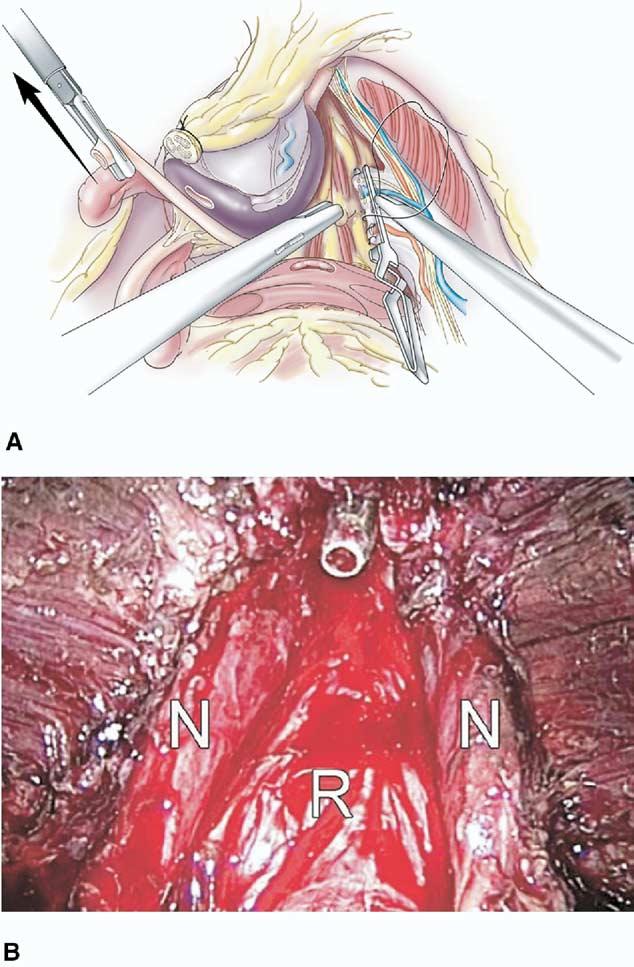 (A) Bulldog clamp in position on right prostate pedicle. (B) Cold cutting of pedicle under real-time TRUS probe monitoring. Reprinted with the permission of The Cleveland Clinic Foundation.
