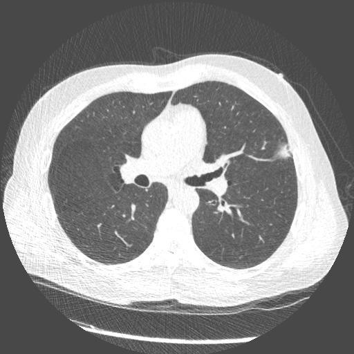 Screening-detected lung
