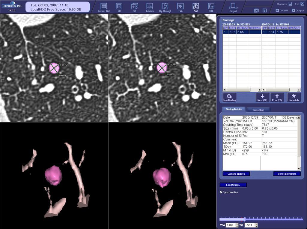 Figure 3: 67-year-old man treated for a laryngeal neoplasm 11 years prior. Top: Transverse CT images from baseline (left) and 103-day follow-up scans (right).