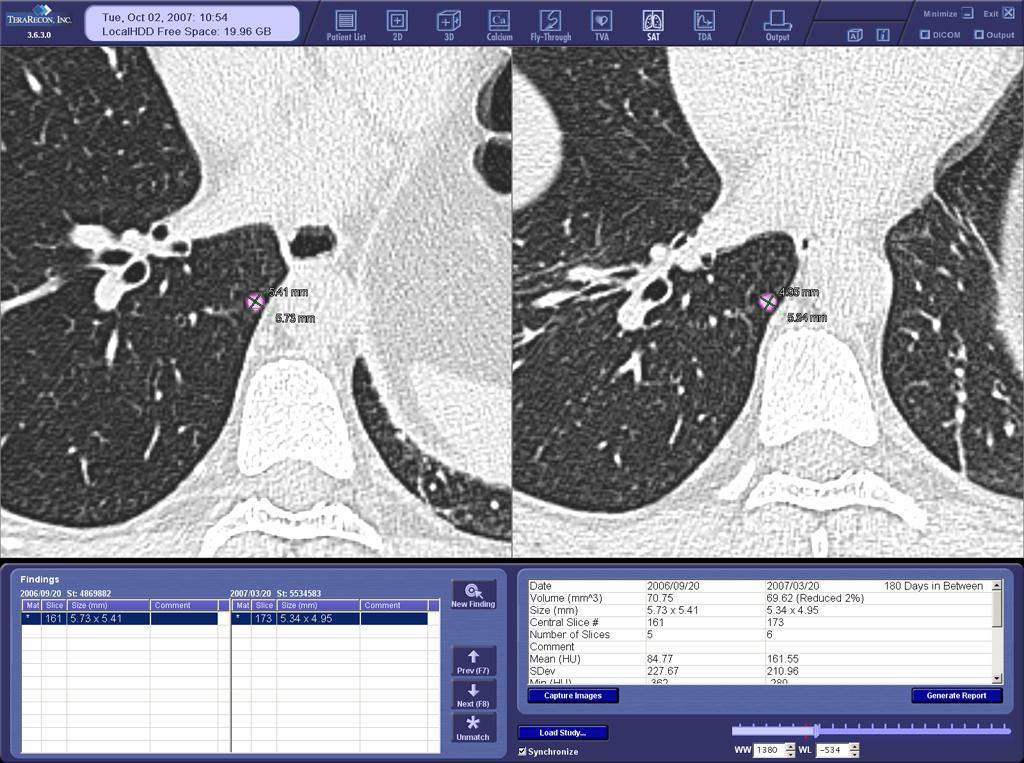 Figure 4: Small nodule in a 57-year-old man. Transverse CT images from baseline (left) and 180-day follow-up scans (right). Volumetric nodule reduction (2%) is demonstrated.