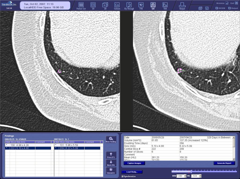 Figure 6: 69-year-old woman already treated for a pulmonary malignancy. Transverse CT images from baseline (left) and 328-day follow-up scans (right).