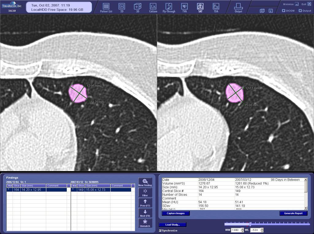 Figure 7: 54-year-old woman, smoker. Baseline (left) and 98-day follow-up (right) CT scans.