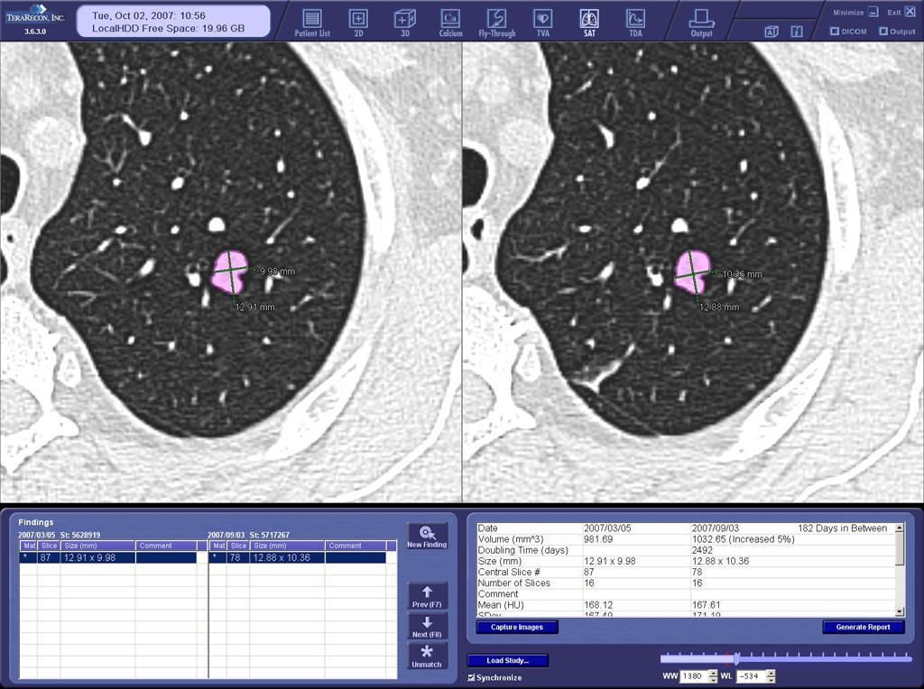 Figure 8: 66-year-old man, smoker. Transverse CT images from baseline (left) and 182- day follow-up (right) scans.
