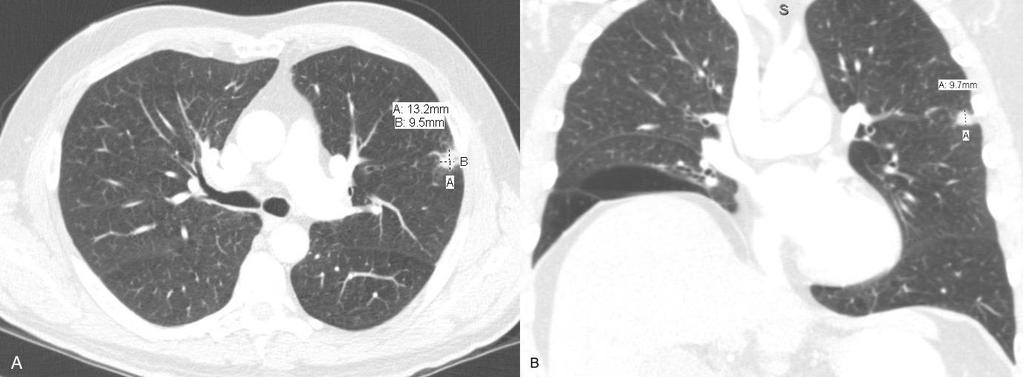 FIGURES Figure 1: 57 year old male with pulmonary dirofilariasis.