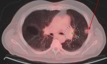 Technique: Curved reformat axial CT, 399 mas, 120 kvp, 2.5 mm slick thickness,60 ml Optiray 350. Figure 4 (right): 57 year old male with pulmonary dirofilariasis.