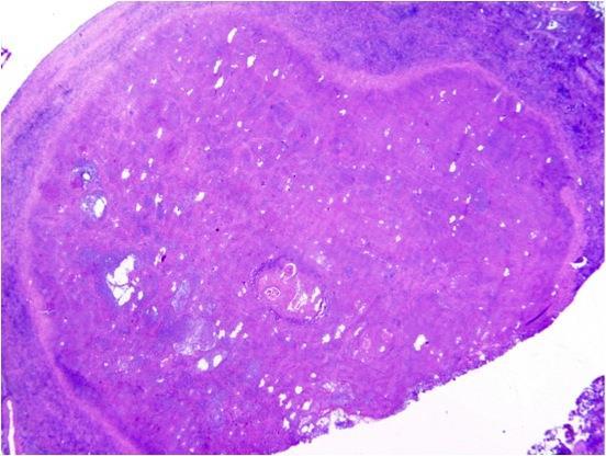Findings: Histopathology demonstrates a granulomatous reaction surrounding a centrally thrombosed artery.