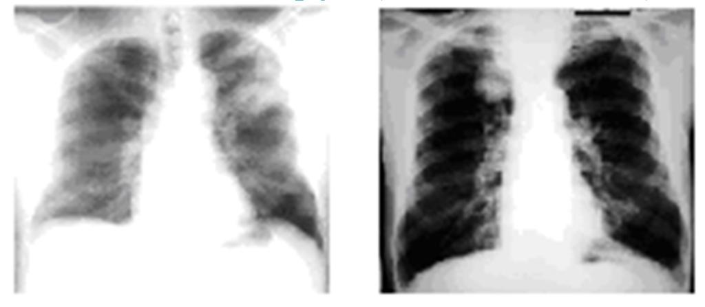 Fig. 1 SCLC and NSCLC images Feature selection is a very important step in organizing a classifier.