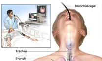 Solitary lung nodule Bronchoscopy Benign Granuloma,