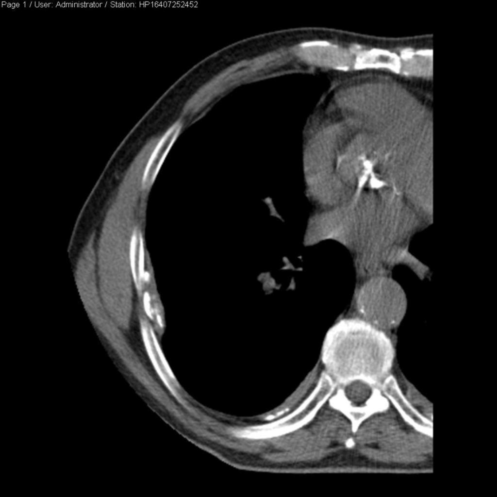 Fig. 1: Calcified pleural
