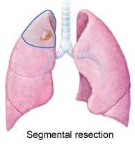 Early Stage Lung Cancer Therapy Low surgical risk High surgical risk