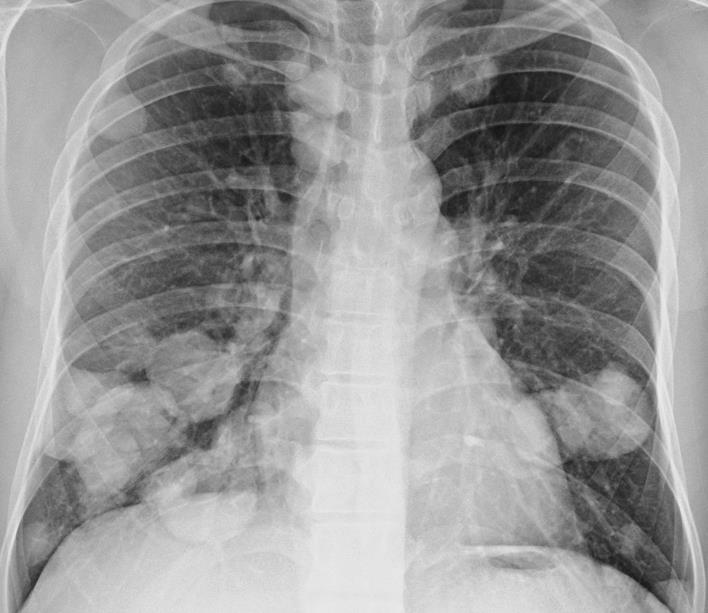 Diffuse Lung