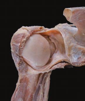 cuff (cut) Acromion (cut) Head of humerus Glenoid cavity of scapula Capsule of shoulder joint (opened)