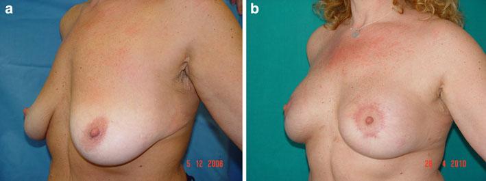 Aesth Plast Surg (2011) 35:593 600 597 8. Breast lifting and fixing.