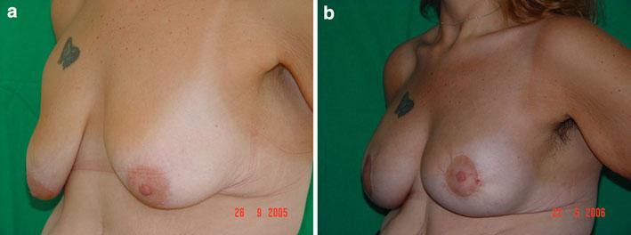598 Aesth Plast Surg (2011) 35:593 600 Fig. 7 Postbariatric breast of a 29-year-old showing laparotomic biliopancreatic diversion and 63 kg of weight loss.