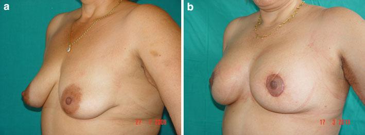 In this case, the indication for the upside-down technique was forced according to the algorithm for postbariatric breast [20] b View 8 months postoperatively, with the NAC still at 20 cm.