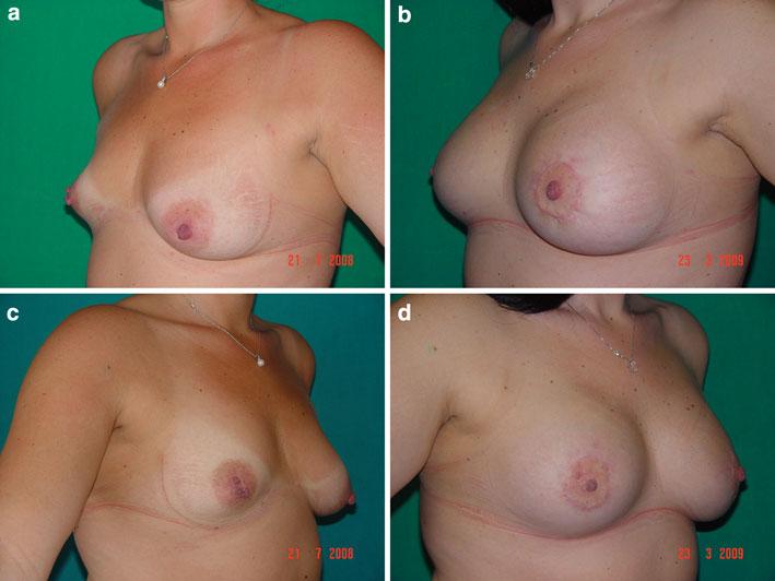 8 Postbariatric breast of a 39-year-old showing laparoscopic biliopancreatic diversion and 52 kg of weight loss. a The NAC is at 24 cm preoperatively (programmed 20 cm postoperatively).