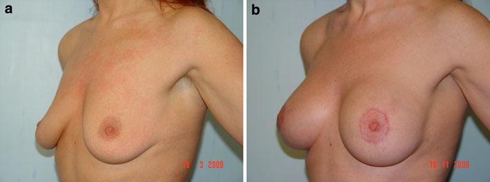 Aesth Plast Surg (2011) 35:593 600 599 Fig. 10 Aesthetic breast of a 40-year-old postpregnant patient requesting an augmentation mastoplasty.