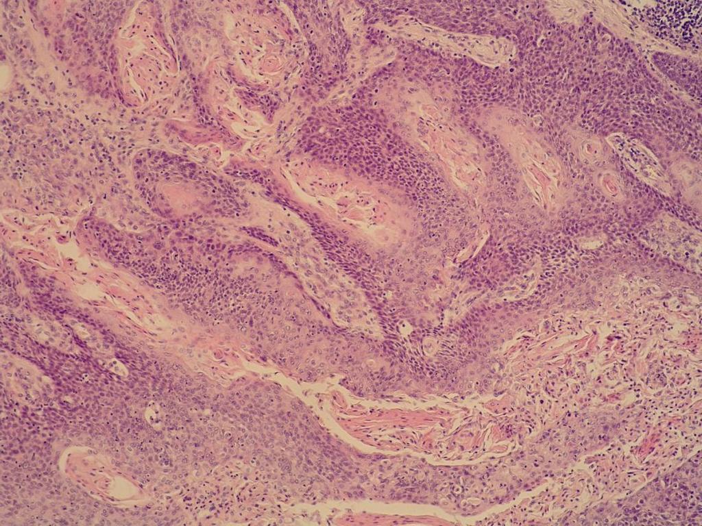 Gradus I Dobro diferencirani planocelularni karcinom sličan je normalnom pločastom epitelu (slika 8).