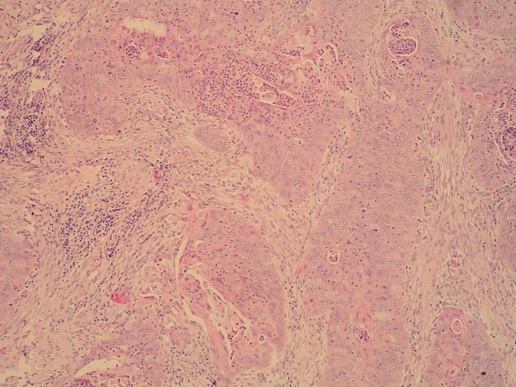 Gradus II Srednje diferencirani planocelularni karcinom ima jasan pleomorfizam jezgara i vidljive mitoze, uključujući i
