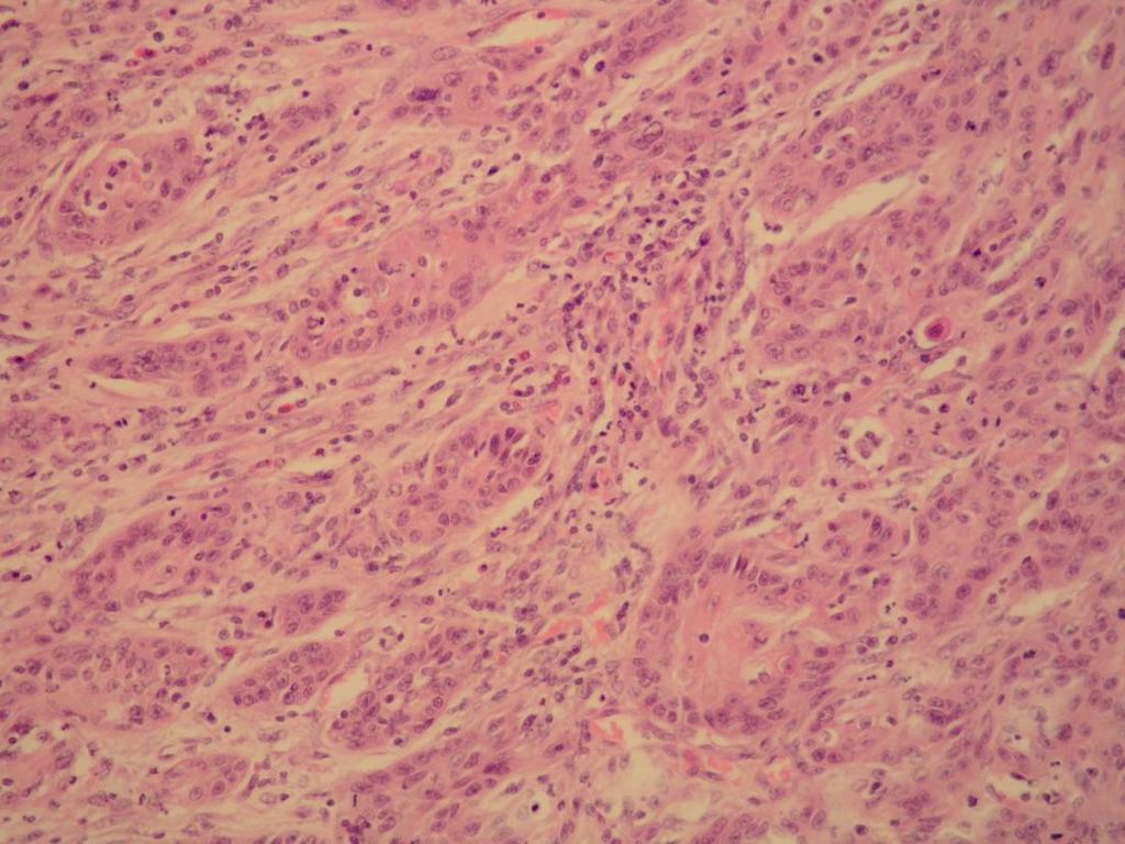 Gradus III Slabo diferencirani planocelularni karcinom sastoji se od nezrelih stanica, s brojnim tipičnim i atipičnim mitozama i minimalnom keratinizacijom (slika 10). Slika 10.