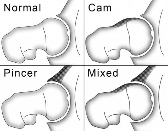Femoroacetabular Impingement Pathologic hip structure effects the loading characteristics of the hip Loss of