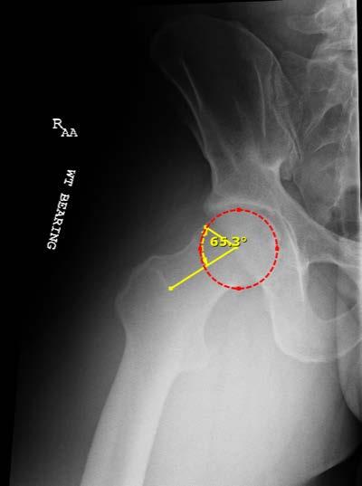 Xrays Modified Dunn Lateral Hip Flexed to 45 o and 20 o abduction
