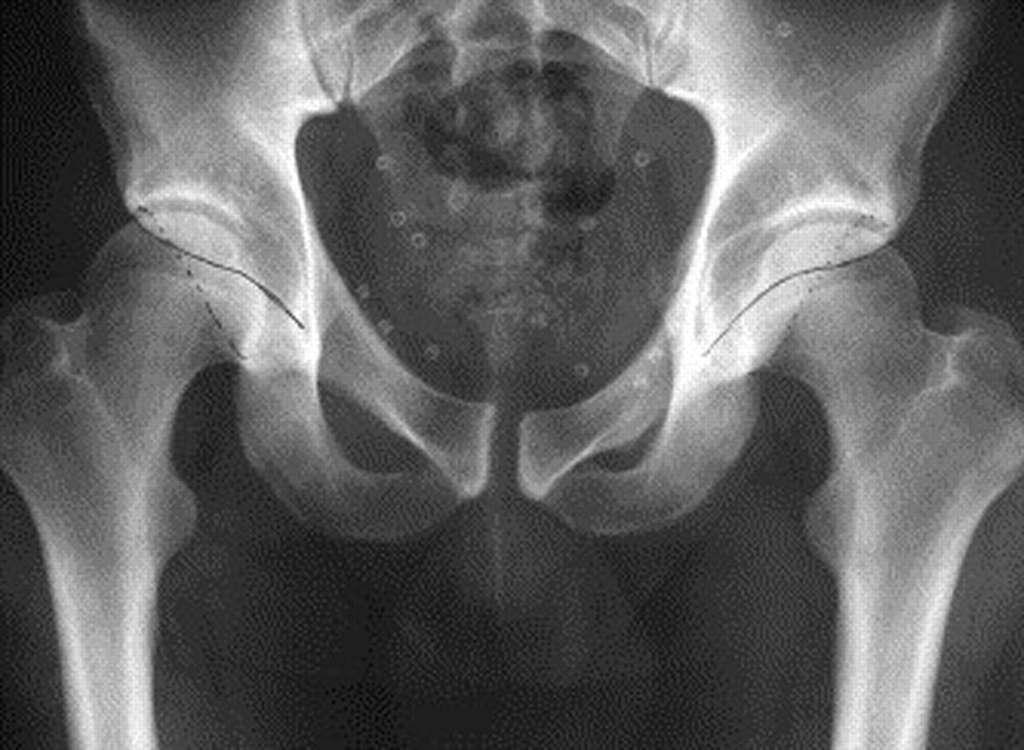 AP radiograph of the pelvis crossover