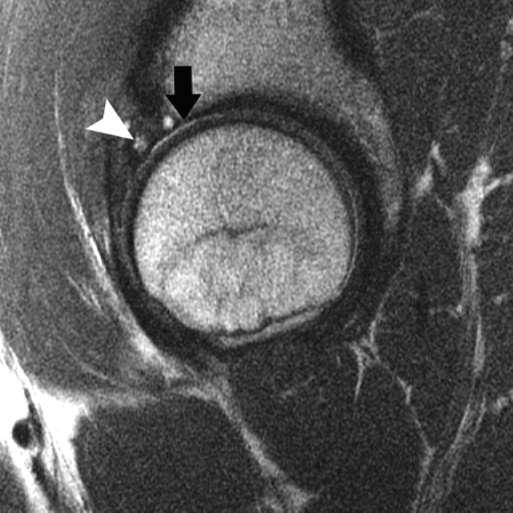 MRI - forty-one-year-old patient with cam-type FAI
