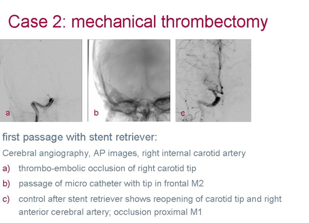 Fig. 5: Case 2: mechanical thrombectomy
