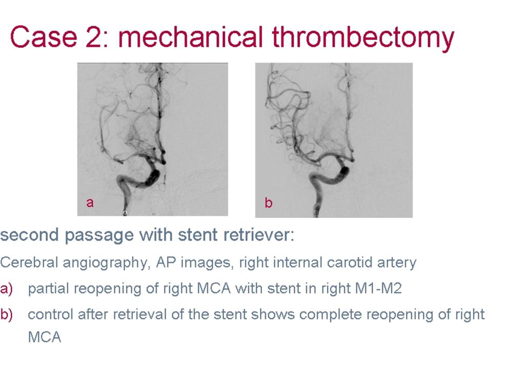 Fig. 6: Case 2: mechanical thrombectomy
