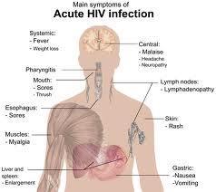 HIV/AIDS SYMPTOMS EARLY STAGES OF HIV Fever (this is the most common symptom)