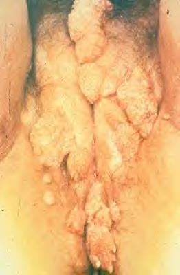 HUMAN PAPILLOMA (HPV)/
